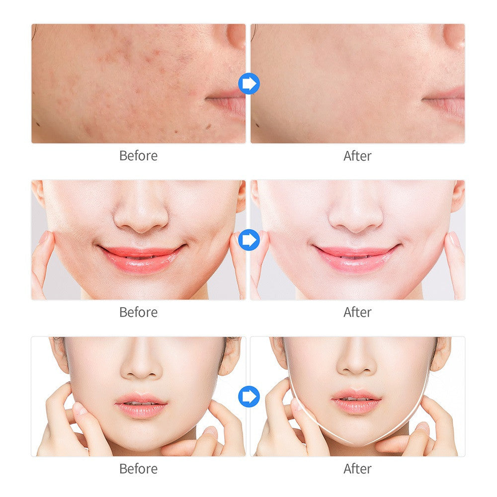 Plasma Cleansing And Acne Rejuvenation Beauty Instrument