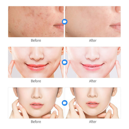 Plasma Cleansing And Acne Rejuvenation Beauty Instrument